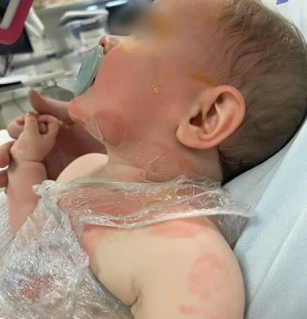Nine-month-old Luka was horrifically burned by a stranger during a picnic