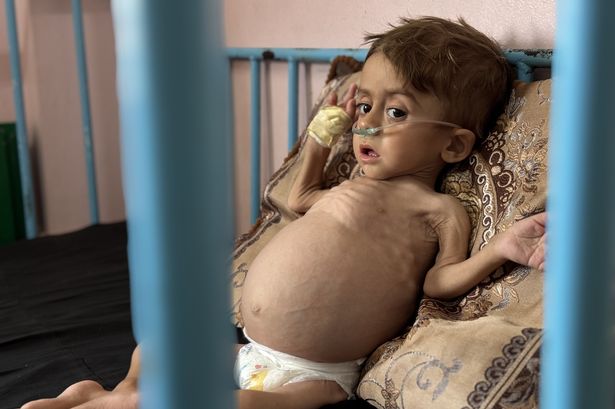 Karim Muammer, who suffers from many serious conditions such as severe malnutrition, liver enlargement, bone softening, kidney leakage, and severe chest infections