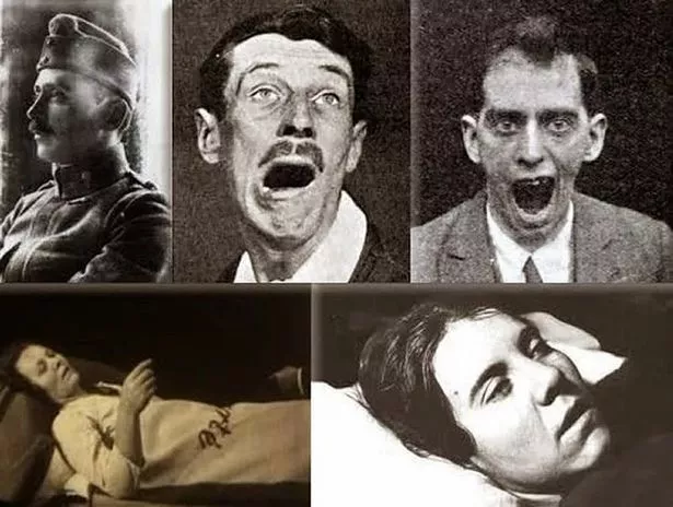 Encephalitis lethargica patients