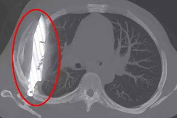An image of the knife inside the chest of the man