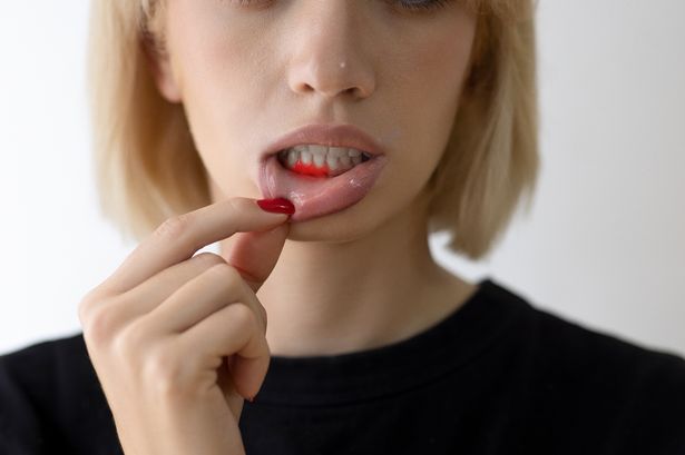 Woman showing inflamed gums - a symptom of scury
