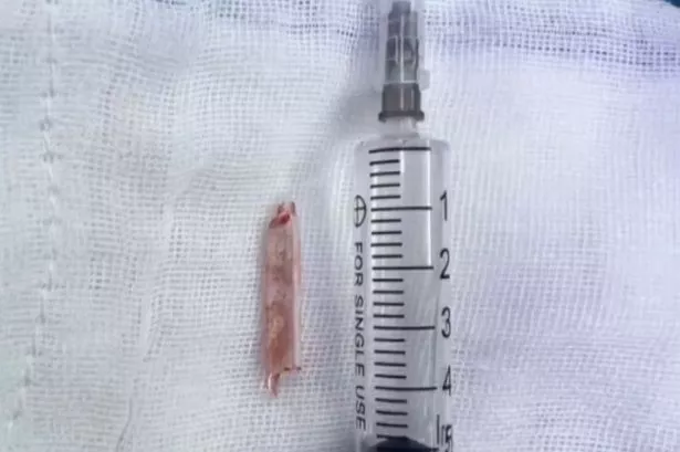 Pictured: The broken piece of a thermometer after being removed from the inside of Ms Hu’s bum.