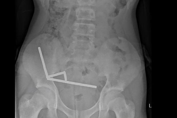 undated handout released on October 24, 2025 from the New Zealand Medical Journal (NZMJ) shows an x-ray image of pieces of high-power magnets clumped up in the intenstines of a New Zealand teenager