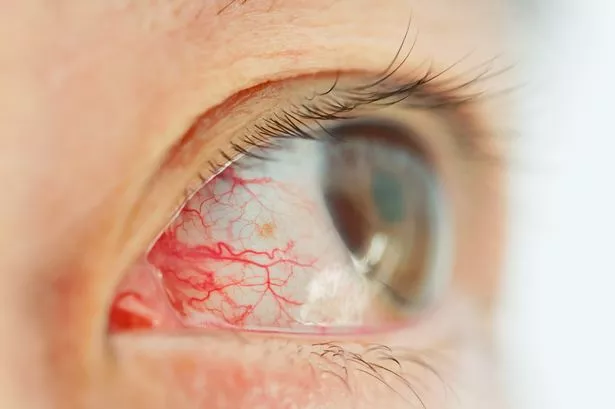 Close-up of a woman with red eye and irritation around the cornea
