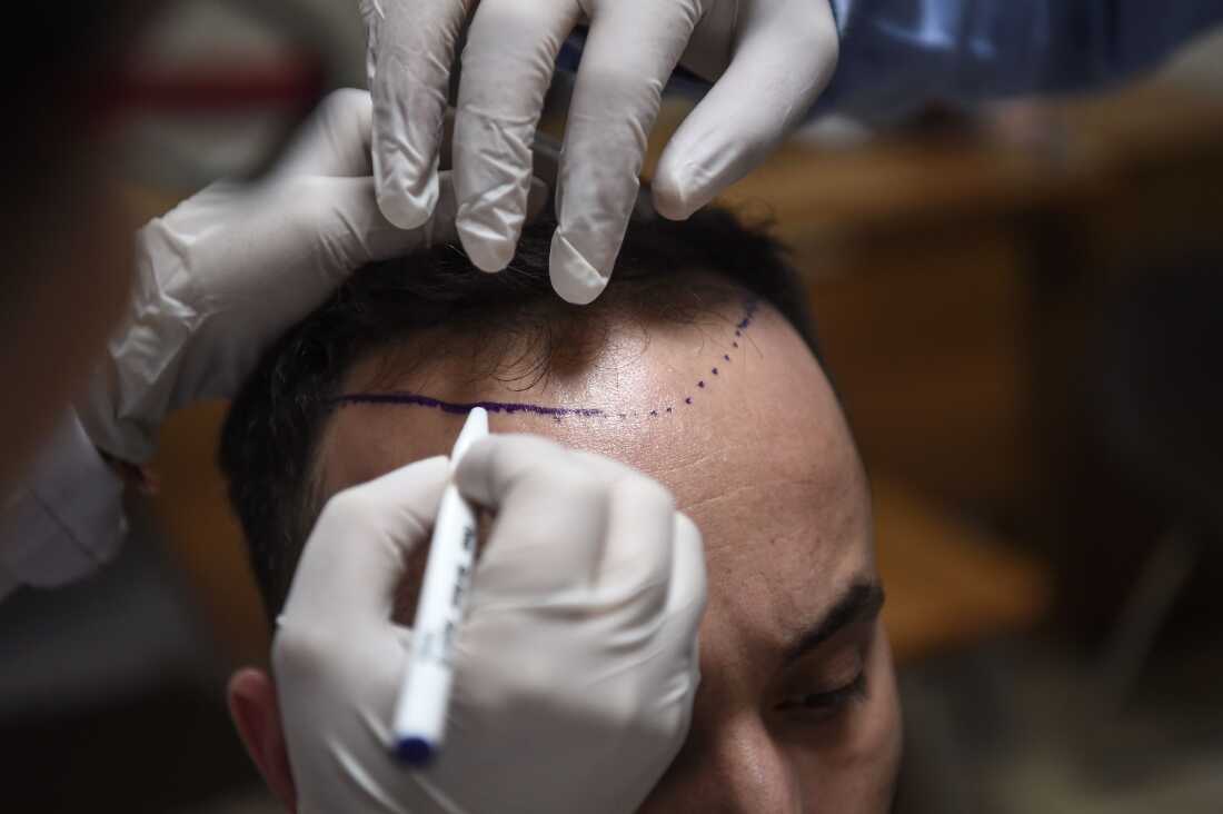 With hundreds of clinics specialized in hair transplants, Istanbul is a growing hub in the industry, attracting people from all over the world.